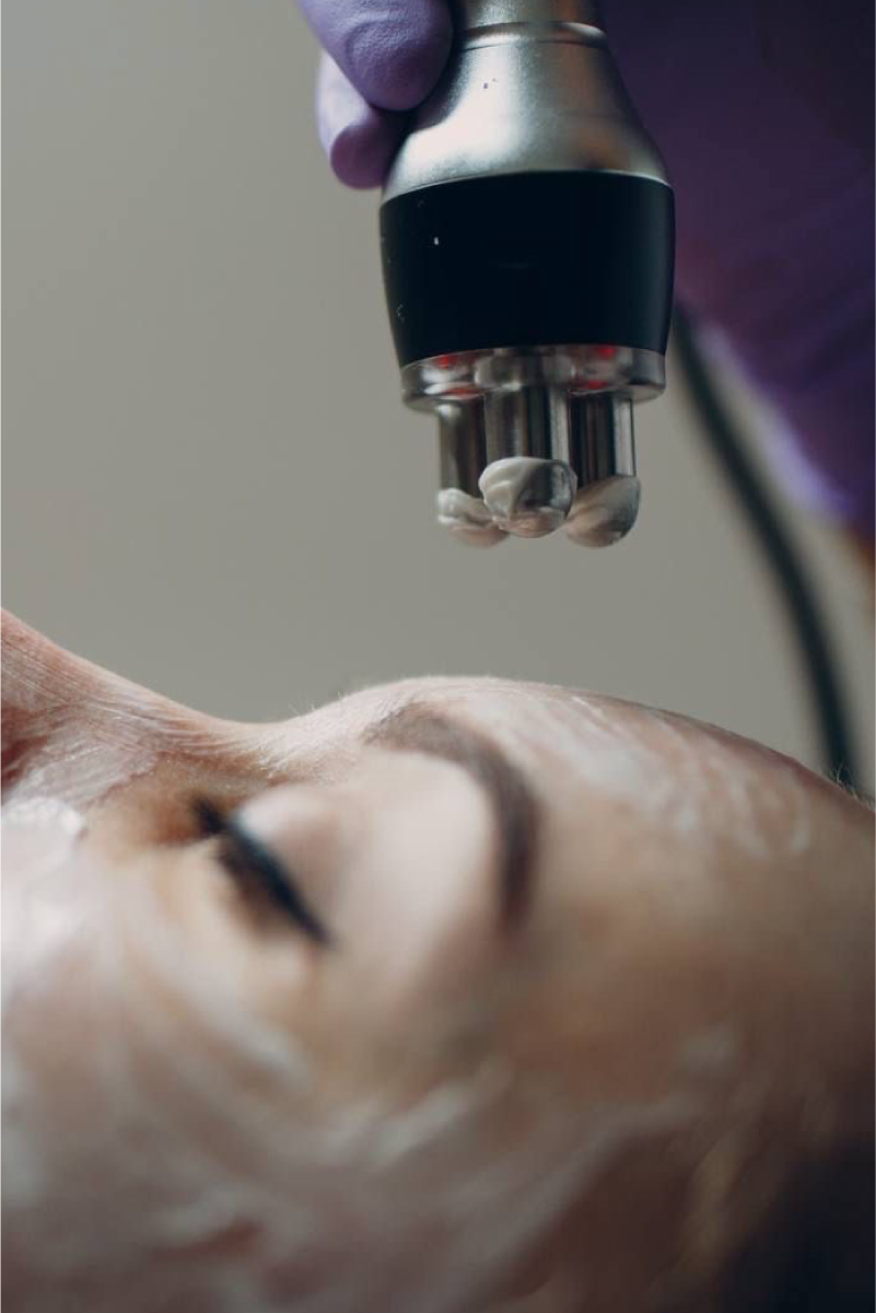 Radiofrequency Facial
